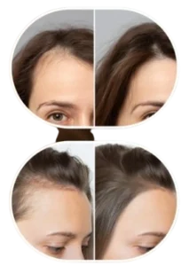 Roota Hair Growth Serum Bafore And After